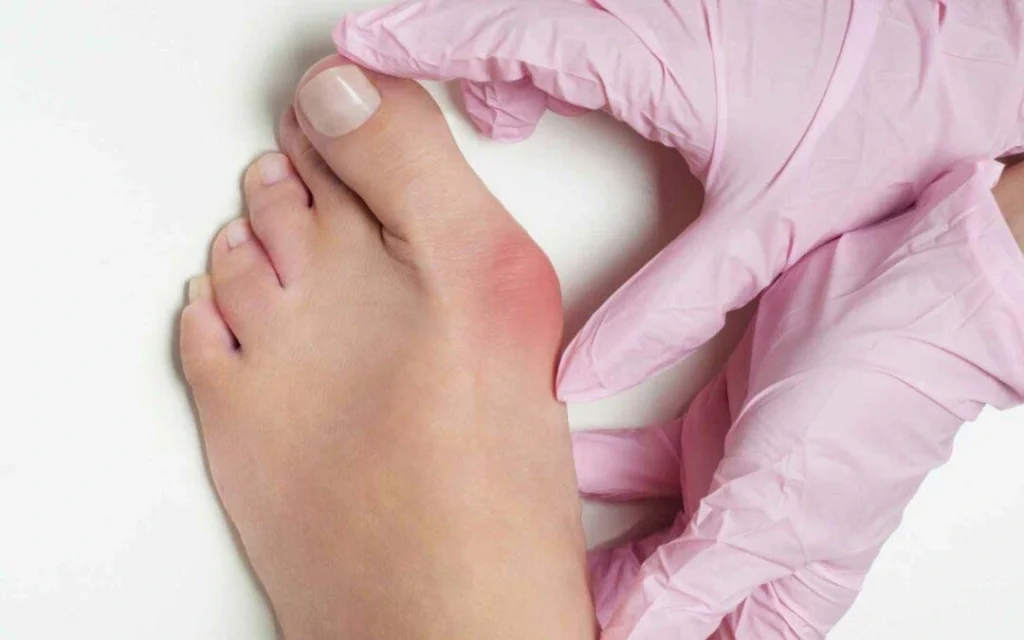 Why Treating a Bunion Early Can Save Your Feet
