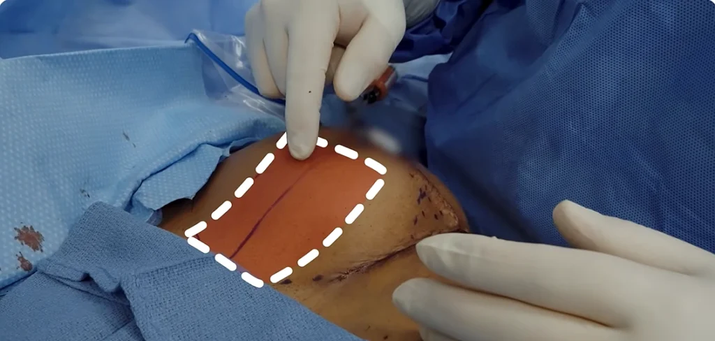Fat Grafting as a Solution for Natural Breast Enhancement